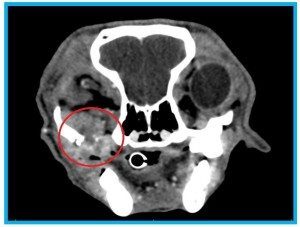 melanoma CT image 